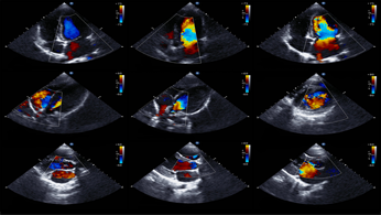 Ecocardiocolordoppler